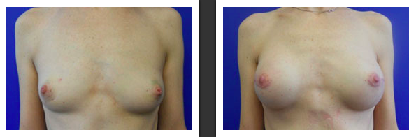 Breast Reconstruction Via Nipple Sparing Implant